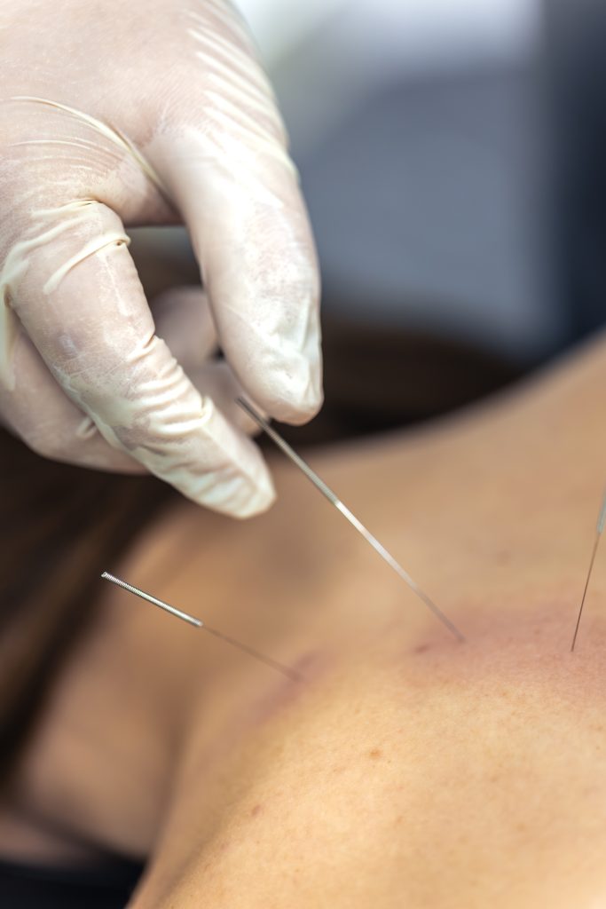 Akupunktur ve Kuru İğne Tedavisi Neden Tercih Edilmeli